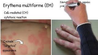 Erythema Multiform  Simply explained skin redness and rush pinkred ring around a pale center [upl. by Eetnod]