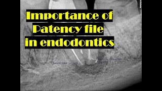 Importance of Patency file [upl. by Barnes]