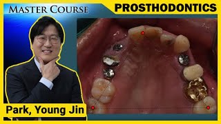 Master Course Season2 PROSTHODONTICS Bite Registration [upl. by Atilrahc]