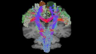 Part II  Informing Neurosurgical Disconnections with Connectomics [upl. by Ettedo]