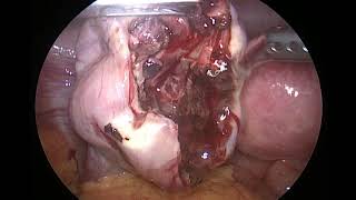 hemorrhagic ovarian cyst [upl. by Nev]