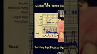 How to record a perio chart [upl. by Halimaj]