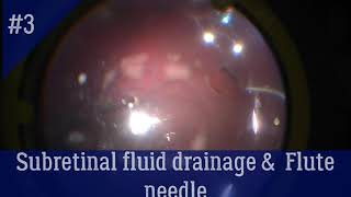 Subretinal fluid drainage and flute needle [upl. by Dugas]