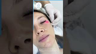 Non surgical under eye lifting with Endolaser for our patient from Germany [upl. by Ikram304]