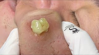 cystic acne blackhead whitehead removal  Relaxing Spa Acne Treatment [upl. by Alida327]