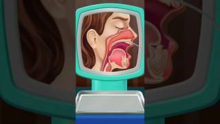 throat treatment animation  throat surgery❤️‍🔥 shortvideo youtubeshort [upl. by Omero]