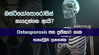 ඔස්ටියෝපොරෝසිස් ගැන දැනගමු 😨 Osteoporosis  symptoms  causes  treatment in sinhala [upl. by Olcott]