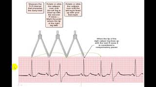 EKG EXTRASYSTOLES [upl. by Glorianna]