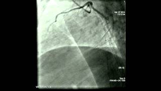 Coronary angiography procedure [upl. by Caldeira756]