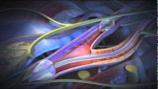 Angioplasty Stenting Atherectomy and Thrombolysis [upl. by Annaiel]