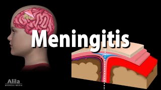 Meningitis Pathology Causes Symptoms Diagnosis and Treatment Animation [upl. by Anuahs]