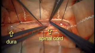 Dr Ali Bydon Performs A Spinal Cord AV Fistula Repair [upl. by Isiad760]