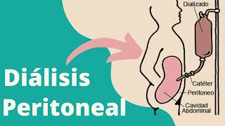 ¿Qué es la diálisis peritoneal [upl. by Eiddet]