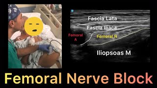 Femoral Nerve Block  Ultrasound Guided [upl. by Bisset]