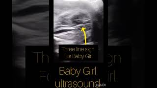 Gender reveal ultrasoundGirl ultrasound report100larki on ultrasoundyoutubeshortsviralshort [upl. by Juanita]