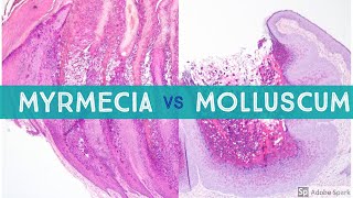 Molluscum vs Myrmecia Wart  Dermpath Lookalikes [upl. by Ambrose]