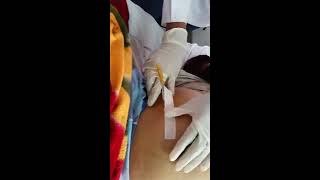 Tapping procedure for Ascites quot Paracentesis quot 1 [upl. by Madden]