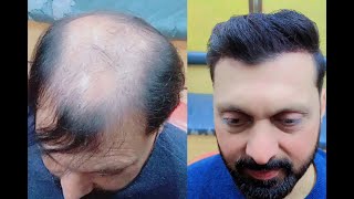 Fibre hairstyle 🔥for very thin hair 😱2024hairstyle haircut fibre building fibre omansaloon [upl. by Allenod]