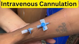 Intravenous Cannulation IV cannula  Full Cannulation  Cannula fixing Injection cannula [upl. by Luamaj]