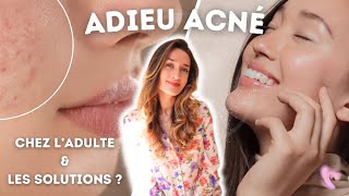 TIPS  COMMENT SE DÉBARRASSER DE LACNÉ ADULTE  cosmétiques alimentation stress solutions [upl. by Aicnom]