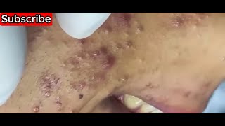 acne blackheads whiteheads removal  deep hard to get blackheads youtube [upl. by Waldack]