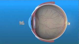 Intraocular Lens IOL [upl. by Mendes]