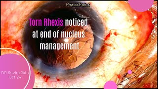 Torn edge of Rhexis noticed at the end of Nucleus Management in Phacoemulsification  Way forward [upl. by Fredenburg]