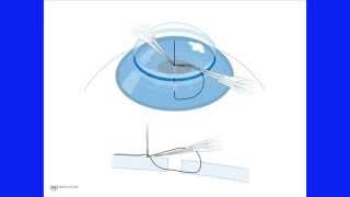 Corneal Suturing Part 6  Integrating the Steps Into a Whole [upl. by Hsara]