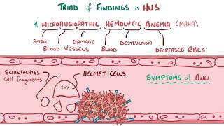 Hemolytic uremic syndrome [upl. by Reifel423]