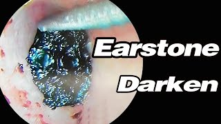 Ear Picking Darkening Of Ear Stones With Foreign Body SensationASMRearwax耳掃除 [upl. by Ayt394]