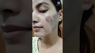 TCA Peel Remove 5th Day Chemical peel remove [upl. by Armillas396]