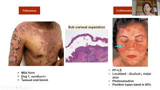 Lecture vesiculobullous disease [upl. by Imuya]