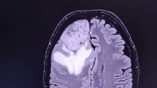 Aggressive meningioma  CT venogram and MRI [upl. by Erkan672]