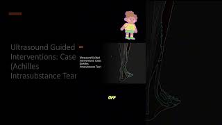 ultrasound Guided Interventions cases Achilles Intrasubstance Tear sports sportsmedicine fyp [upl. by Treblig793]