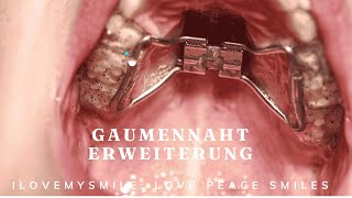 Gaumennahterweiterung was ist das [upl. by Curley]