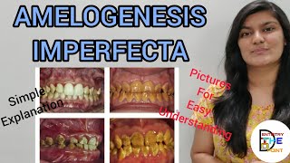 AMELOGENESIS IMPERFECTA  DEVELOPMENTAL DISTURBANCES IN STRUCTURE OF TEETH [upl. by Aicnarf362]