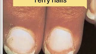 Quick review of Paronychia  Clubbing of fingers Melanonychiaonycholysis terry nails  pitting [upl. by Ives883]