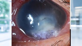 CORNEAL ULCER AND CHOROIDAL DETACHMENT [upl. by Ellehcal532]