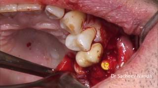 Immediate Implant placement in Maxillary first Molar region with Hard and Soft Tissue Grafting [upl. by Silvano]