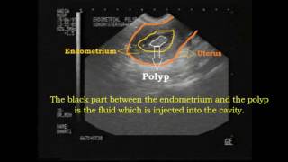 ENDOMETRIAL POLYP ON SONOHYSTEROGRAPHY  Ankoor Fertility Clinic Mumbai [upl. by Amitak]