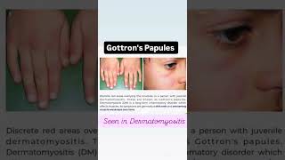 GOTTRONS PAPULES DERMATOMYOSITIS shorts aiapget neetpg viralvideo [upl. by Lienet351]