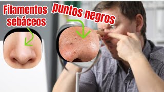 Cómo deshacerse de los puntos negros y los filamentos sebáceos Dr Iceberg [upl. by Jarin855]