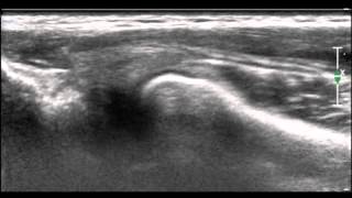 Ultrasonographic diagnosis of snapping annular ligament in the elbow [upl. by Ahsemac871]