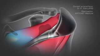 Arthroscopie de lépaule  Acromioplastie [upl. by Bortz]