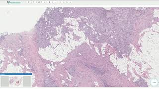 Fibrous Hamartoma of Infancy  Histopathology [upl. by Artkele]