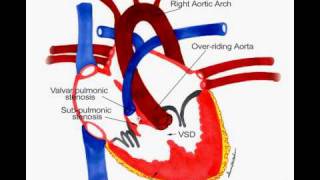 Tetralogy of Fallotavi [upl. by Aguste468]