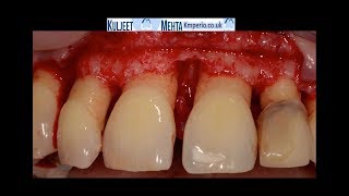 Periodontal Surgery Upper Front Teeth [upl. by Accem715]