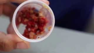 Sharp spikey bladder stones removed Pt 3 [upl. by Annette]