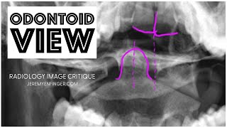 Radiology Image Critique Odontoid View [upl. by Ajile]