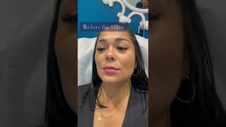 The TRUTH About Lip Fillers You Need to Know with Dr Dahabra in Florida shorts [upl. by Paschasia]